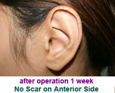 plastic-surgery-prominent-ear 